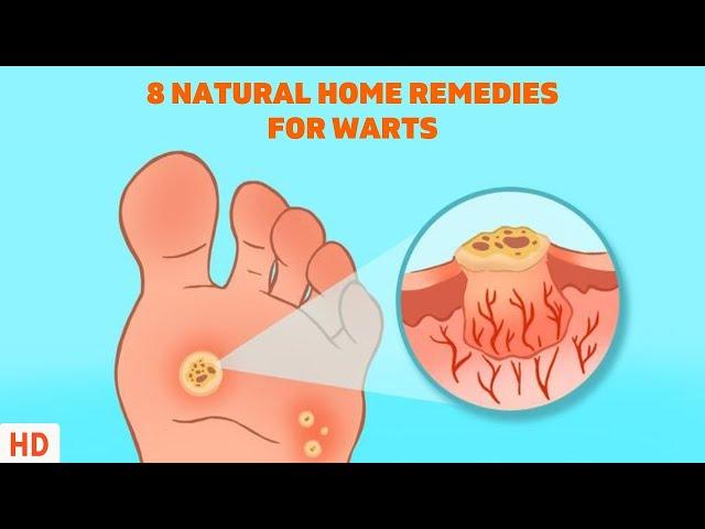 8 Surprising Home Remedies for Warts - Get Rid of Them Naturally!