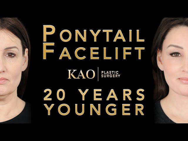 Ponytail Facelift™ Before and After Video With Neck Lift