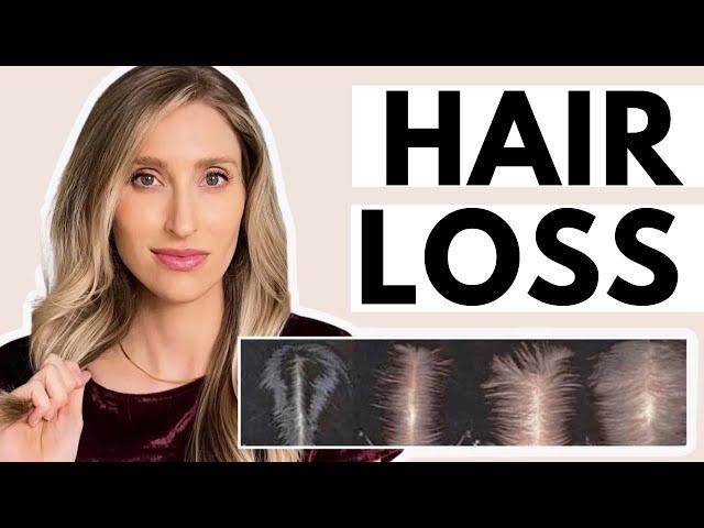 Hair Loss: Dermatologist Shares What Causes it & the Best Treatments (Minoxidil & More!)