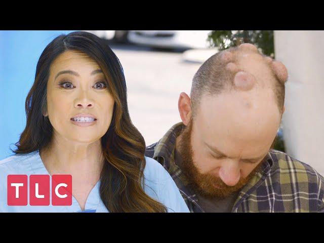 Dr. Lee Extracts ELEVEN Cysts From Man's Head! | Dr. Pimple Popper