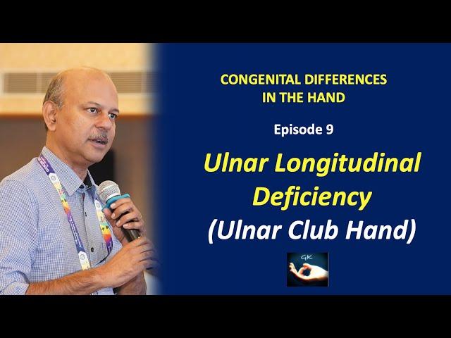 Congenital hand differences: Episode 9 - Ulnar Longitudinal Deficiency or Ulnar Club hand