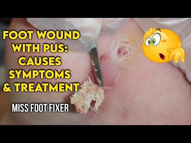 Foot Wound with Pus: Causes, Symptoms, and Treatment | By  Foot Specialist Miss Foot Fixer