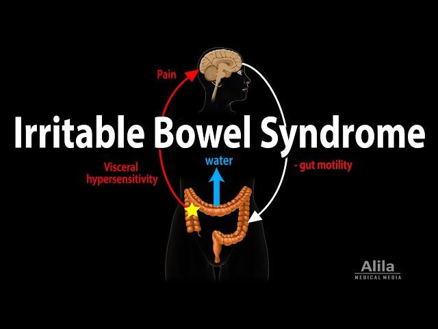 Irritable Bowel Syndrome: Pathophysiology, Symptoms, Causes, Diagnosis and Treatment, Animation