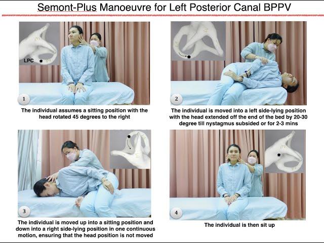 Semont-Plus Manoeuvre for Left Posterior Canal BPPV