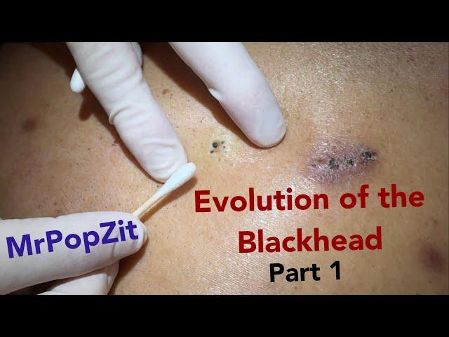 Evolution of the blackhead part 1. The rare trident blackhead! Triple barrel extraction.