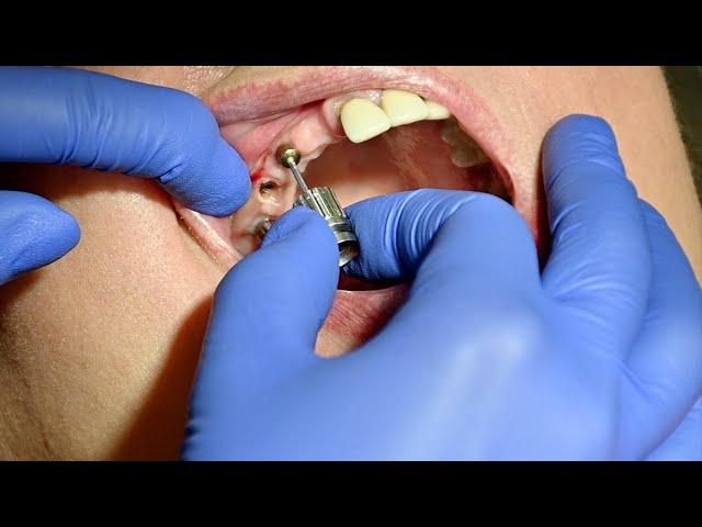 How we do it: 5 crowns for only 3 implants