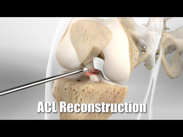 Repairing an ACL injury using a tendon from your own hamstring.