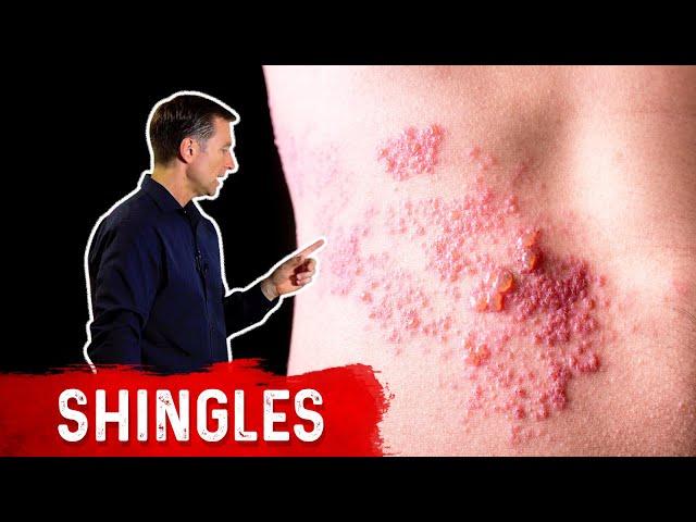 Shingles: Natural Relief