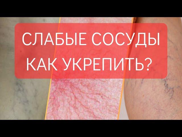 ХРУПКИЕ  И СЛАБЫЕ СОСУДЫ. КАК УКРЕПИТЬ?