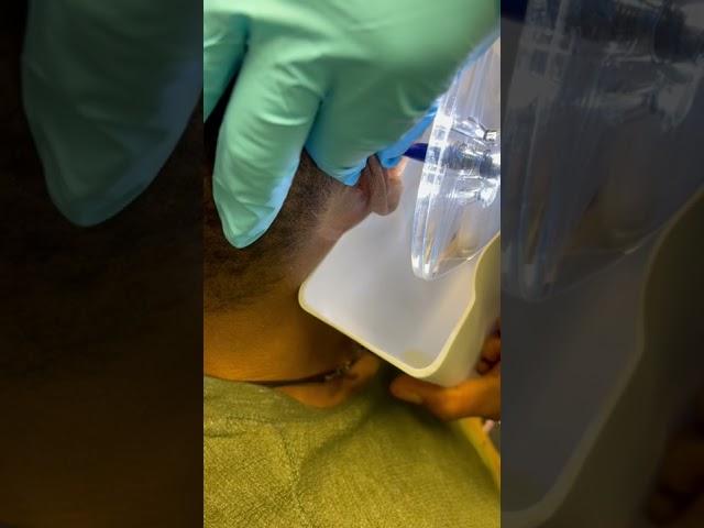 Incredible Ear Cleaning - Dr. Wikoff using the Earigator! #earwaxremoval #drpimplepopper #earwax