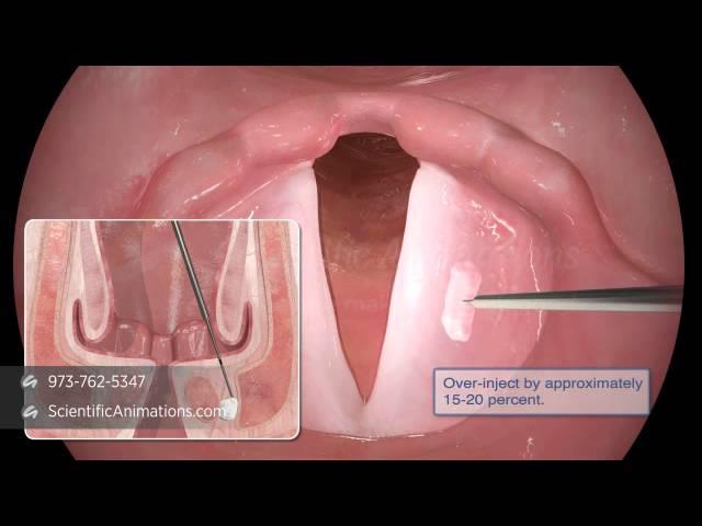 Vocal Cord Paralysis Surgery