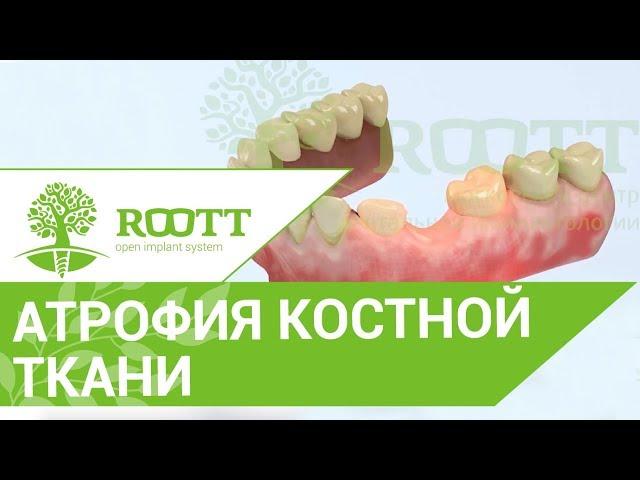 Атрофия костной ткани.  Чем опасна атрофия костной ткани?Клиника ROOTT