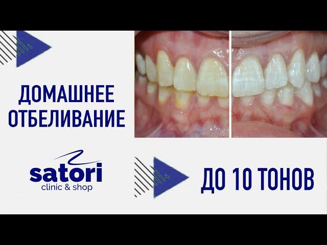 Домашнее отбеливание зубов Оpalescence, капы для отбеливания зубов