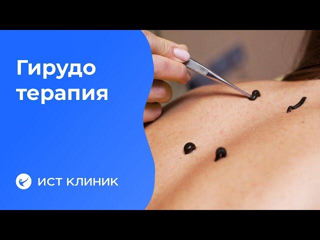 Постановка и лечение медицинскими пиявками (гирудотерапия).