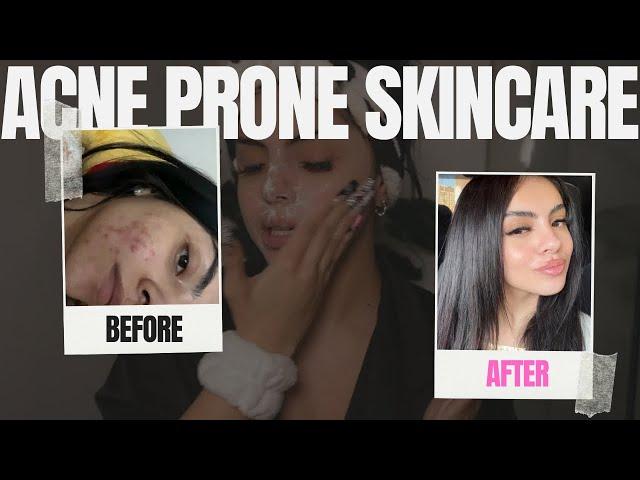 TREATING MY ACNE | skin care+hair care