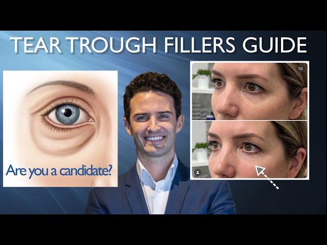 Tear Trough Guide: Are you a candidate?