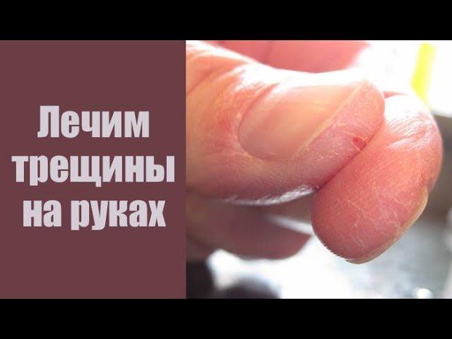 МАЗЬ ПРИ ТРЕЩИНАХ НА РУКАХ