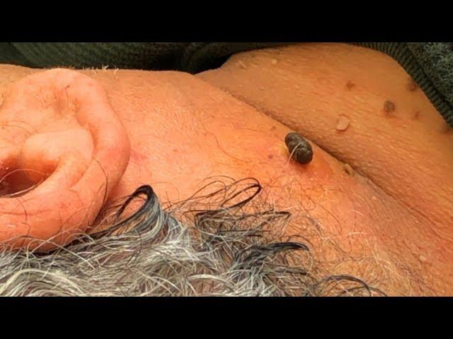 Jellyfish Neck Nevus
