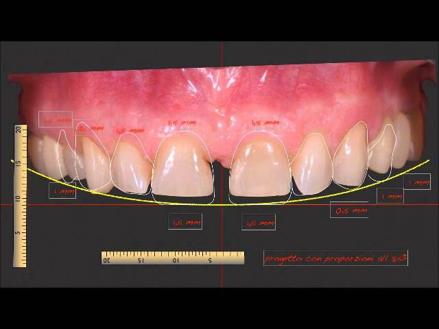 Tecnica di Digital Smile Design | Dottori Dentisti Nobile Studio Dentistico Torino