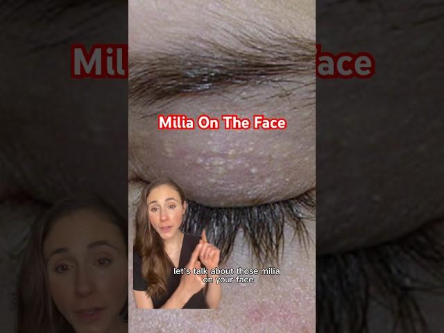 Get Rid Of Your Milia For Good! #dermatologist