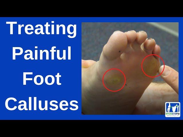 How to Treat Painful Foot Calluses