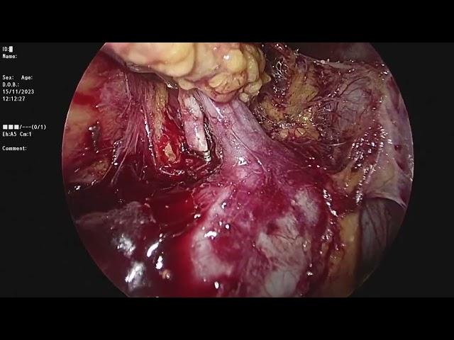 lap Nephrectomy