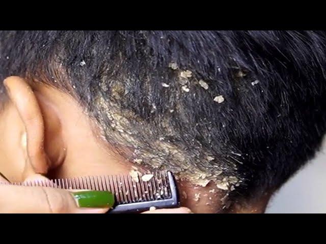 Dandruff scratching removal on head using black combing#190