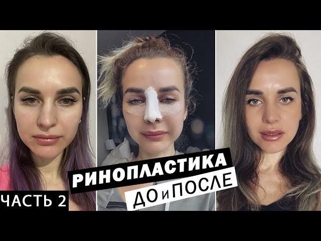 РИНОПЛАСТИКА в Санкт-Петербурге | До и ПОСЛЕ | Реабилитации после ринопластики. Часть 2
