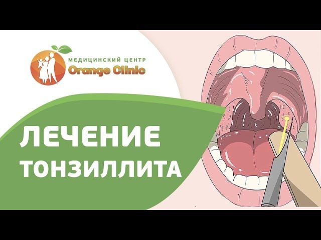  Как проводится лазерная абляция миндалин. Абляция миндалин. Оранж Клинк. 12+