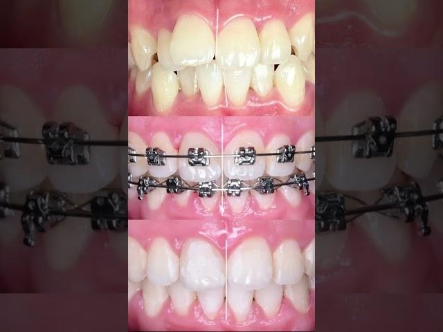 BEST Braces Treatment in Delhi Revealed