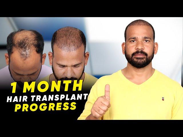 Hair Transplant in Udaipur | Best Results & Cost of Hair Transplant in Udaipur