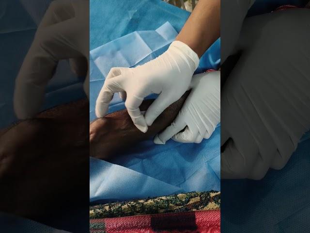 During Dialysis Procedure ofAV fistula cannulation #dialysis  #hospital #dialysis