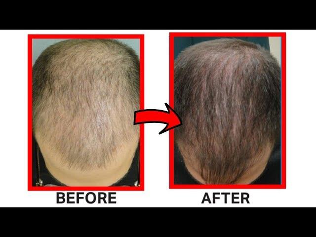 Will PRP Treatment Help you Regrow Hair? PRP Cost and Effectiveness!