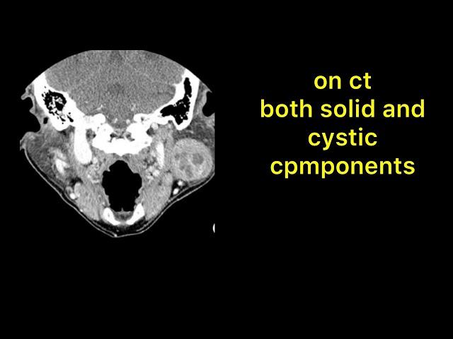 WARTHIN TUMOR RADIOLOGY ON EACH MODALITY.......