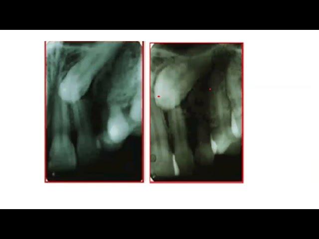 Localization of impacted canine by Parallax or CBCT