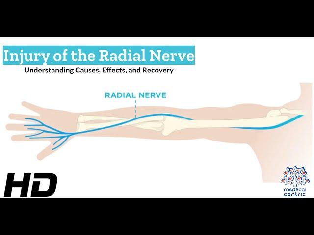 Radial Nerve Injury: What You Need to Know