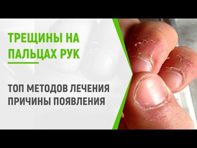 Трещины на пальцах рук: ТОП методов лечения и причины появления