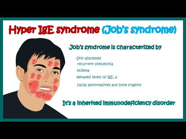 Hyper IgE syndrome (Job's syndrome ) || Immunodeficiency disorder || clinical features