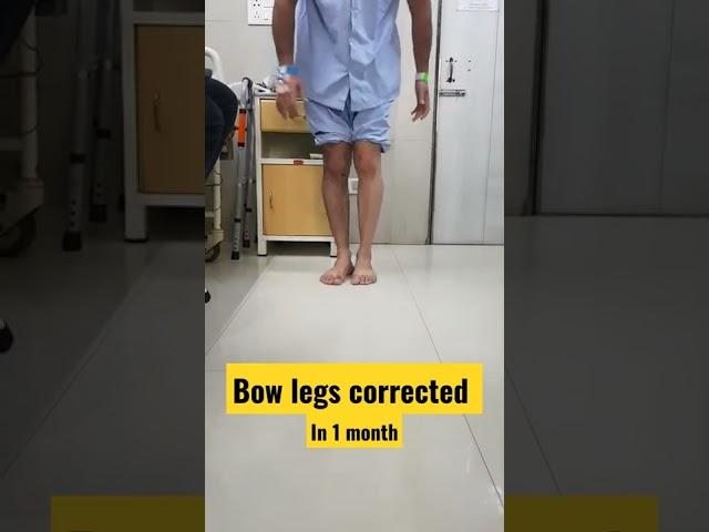 bow legs corrected