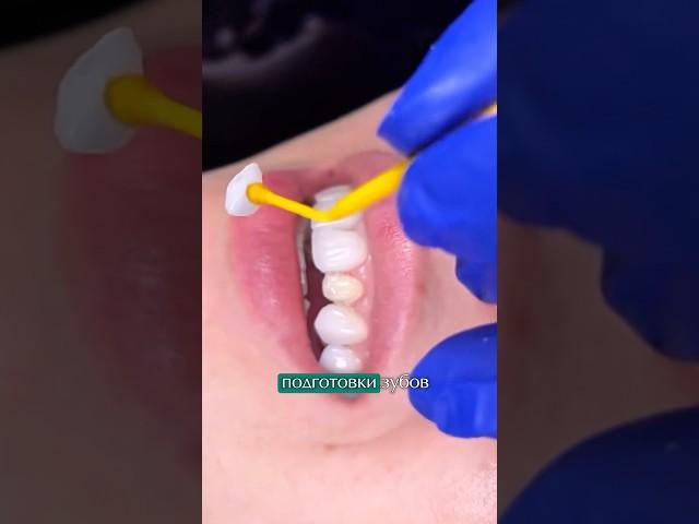 #виниры без обточки зубов #виниры #стоматология #dentist #полезно #dentalclinic #коронки #smile
