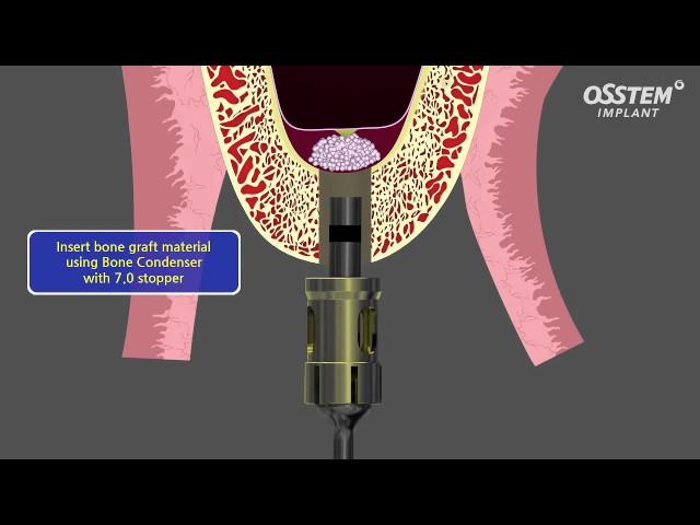 Internal Sinus Lift