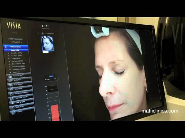 Maffi Clinics: VISIA Skin Analysis