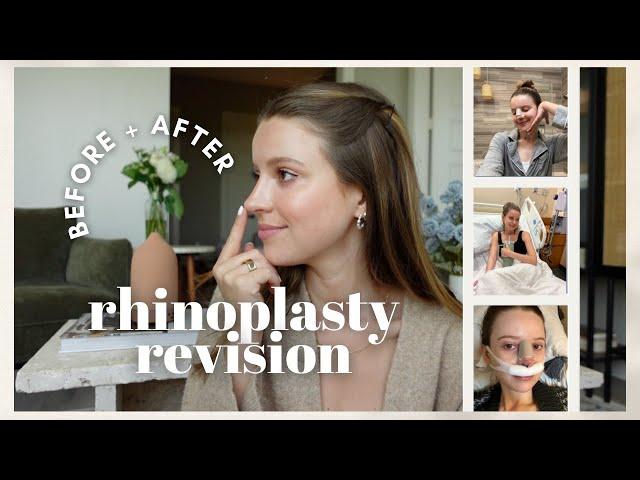 My Rhinoplasty Revision Experience: Before + After, Recovery, Cost + Hospital Stay