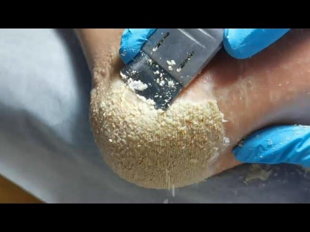 This is for lover of cheese. Cracked heel treatment & Callus removal. Dead skin removal. Foot care.