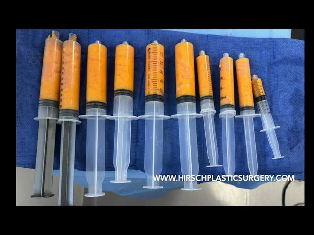 Fat graft to the breast #medical #medicalstudent #breast #health #plasticsurgery #plasticsurgeon
