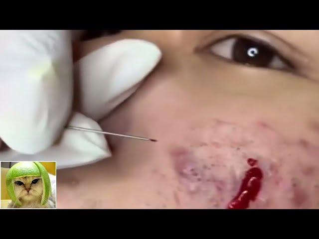 Removes acne | Давим прыщи | чёрные точки | Залипательно 2021