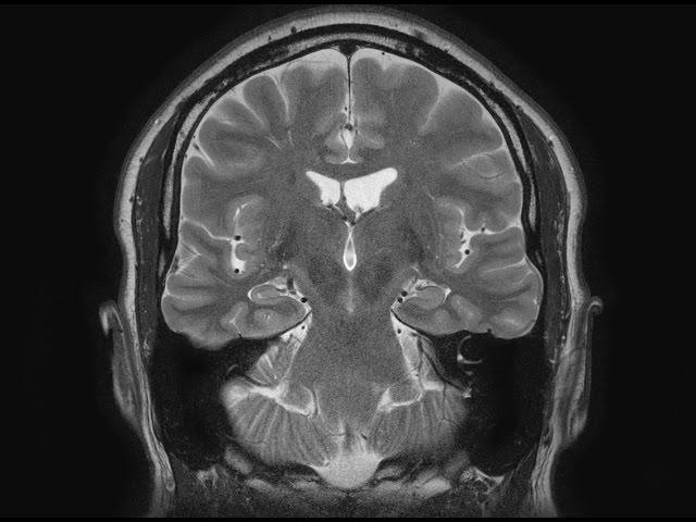 MRI brain scans