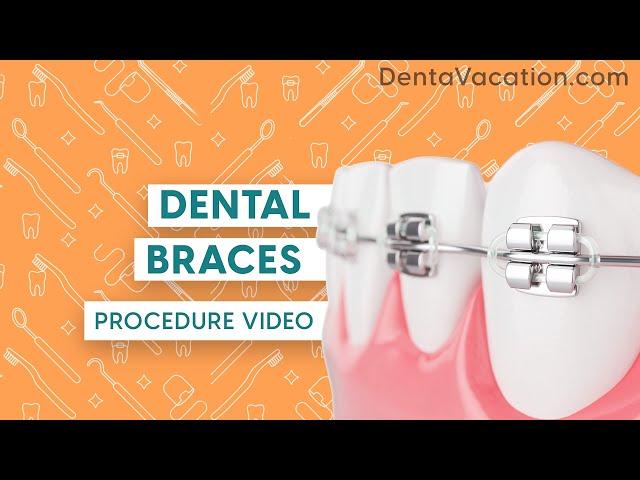 Dental Braces Abroad | DentaVacation