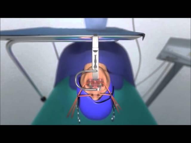 COBLATION◊ Tonsillectomy and Adenoidectomy Animation