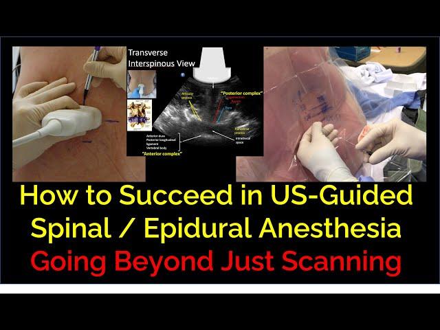 Keys to Success in US-Guided Spinal / Epidural Anesthesia - Beyond Just Scanning